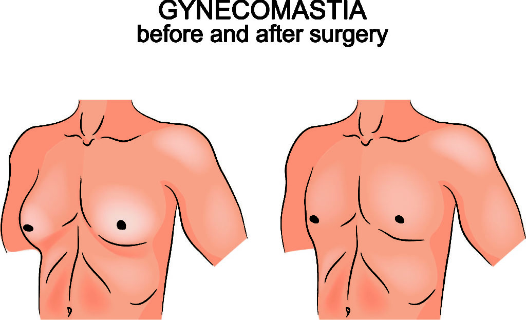 Gynecomastia Is One Of The Most Serious Side Effects Of Risperdal