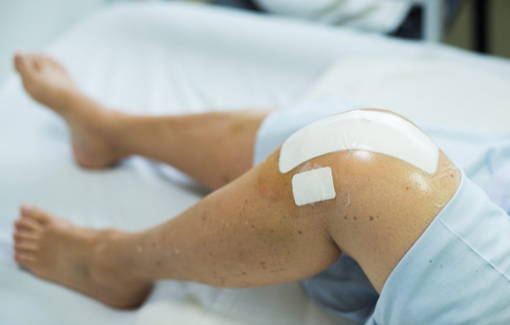 Attune Knee System Lawsuits Are Increasingly Common