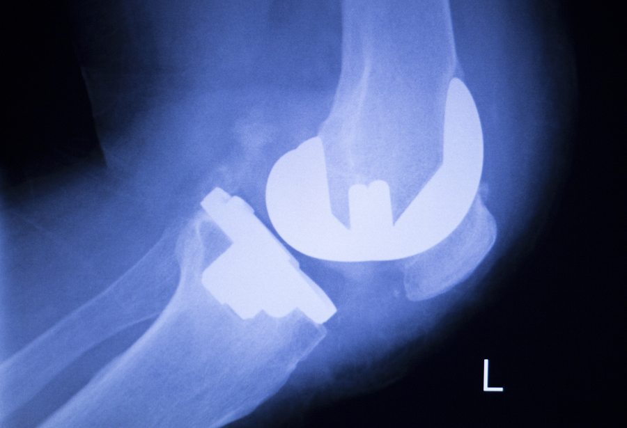 Zimmer Knee Complications