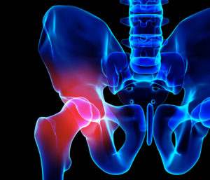 Hip Pain On X-Ray representing depuy ASR hip replacements