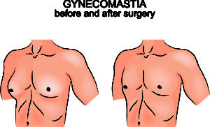 Gynecomastia Is One Of The Most Serious Side Effects Of Risperdal