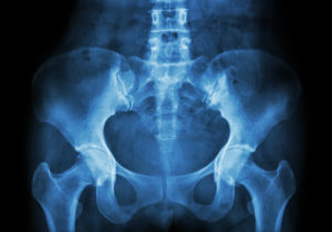 Film X-ray of Pelvis Representing DePuy Hip Replacement Lawsuits