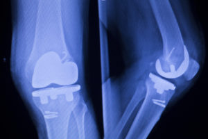 The Attune Knee System Often Experiences Premature Failure