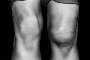 An Injured Knee That Later Received An Attune Knee System Replacement